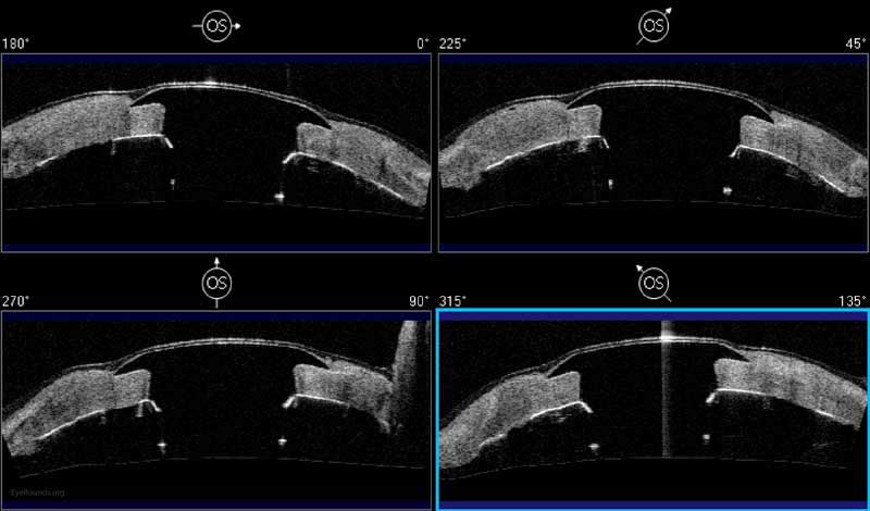 Figure 18: Anterior segment optical coherence tomography demonstrating the appearance of a Boston Type I Kpro with healthy corneal tissue surrounding the device.