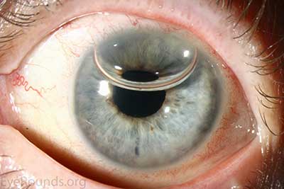 Anterior chamber gas bubbles