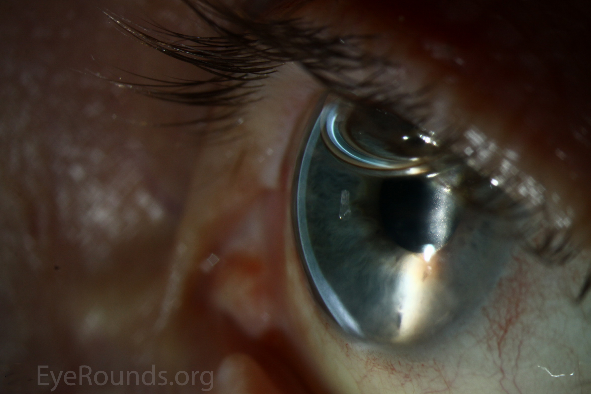 Clear DALK graft 3 years after transplant for keratoconus