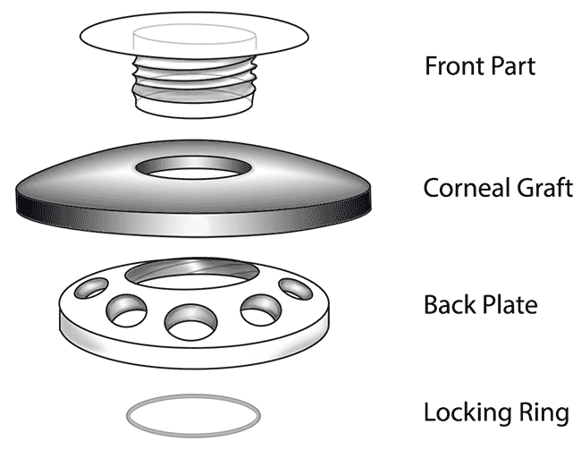 Assembly of the Boston Type I KPro device. Image courtesy of EyeWorld.org. 