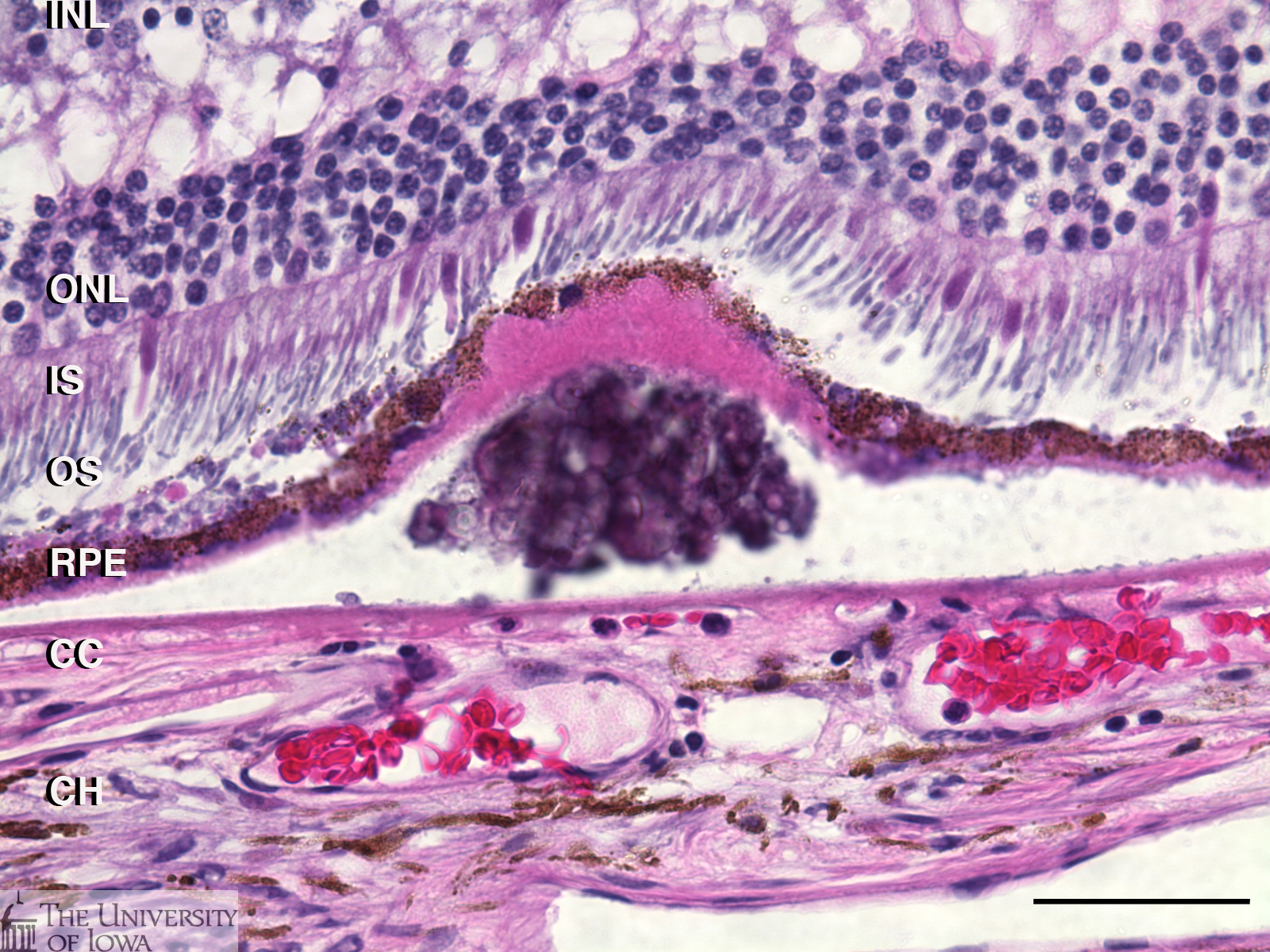 H&E stain shows sub-RPE deposition