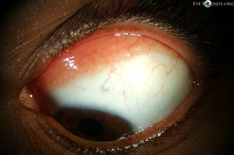 Conjunctival benign lymphoid hyperplasia