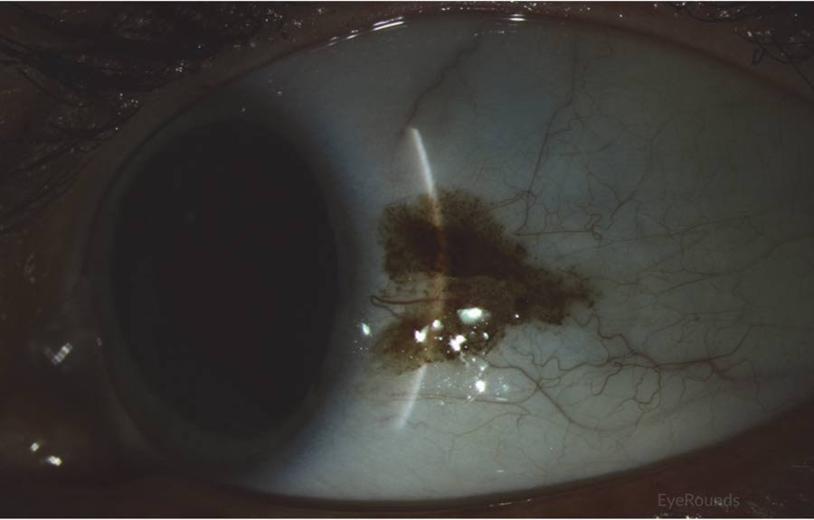 slit lamp of conjunctival melanoma