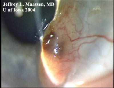 slit lamp showing conjunctival melanoma after resection