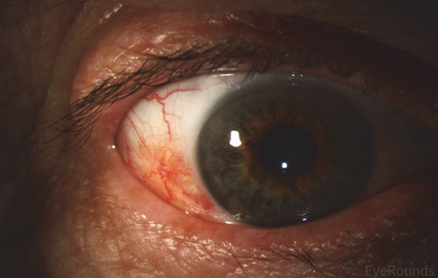 Slit lamp photo displaying conjunctival squamous cell carcinoma in situ