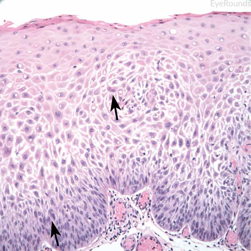 Invasive conjunctival squamous cell carcinoma