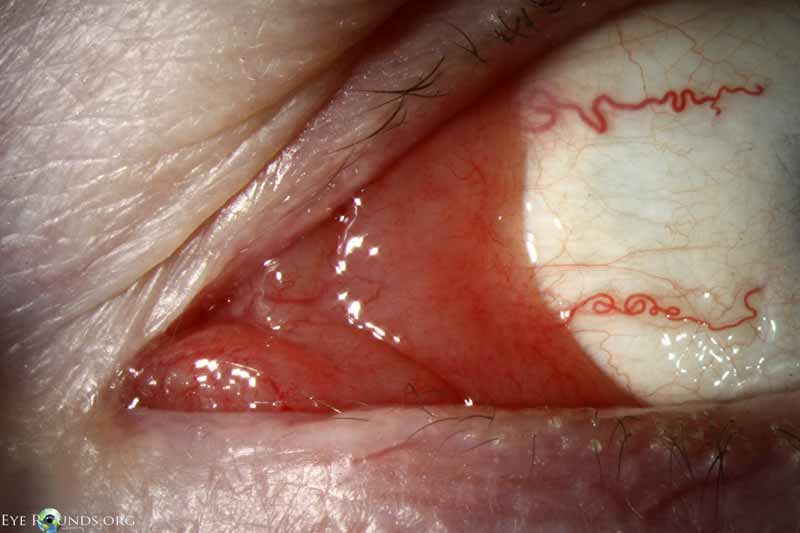 Conjunctival lymphoma 