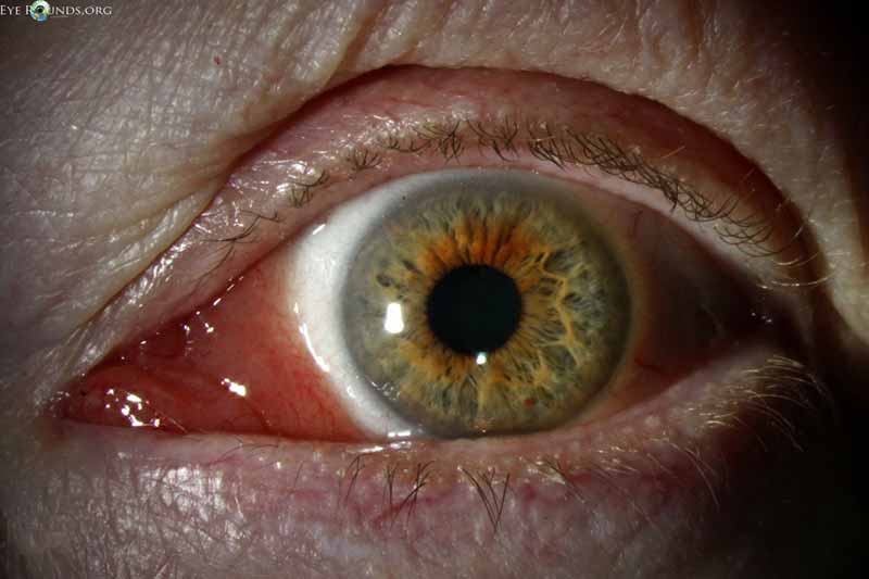 Conjunctival lymphoma 