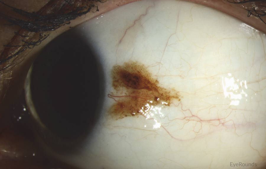 slit lamp of conjunctival melanoma