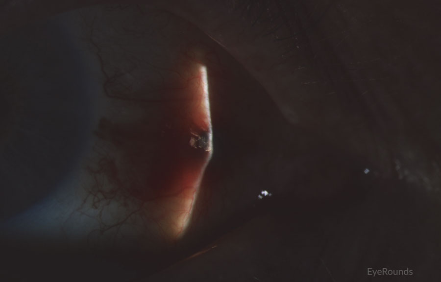 Slit lamp photograph demonstrating recurrence of amelanotic melanoma with underlying scleral degeneration