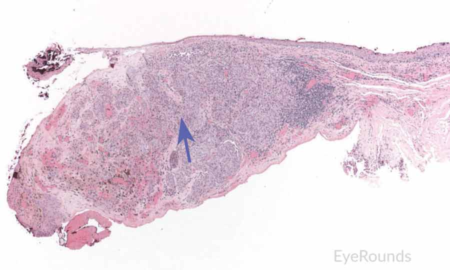 Primary acquired melanosis with severe atypia