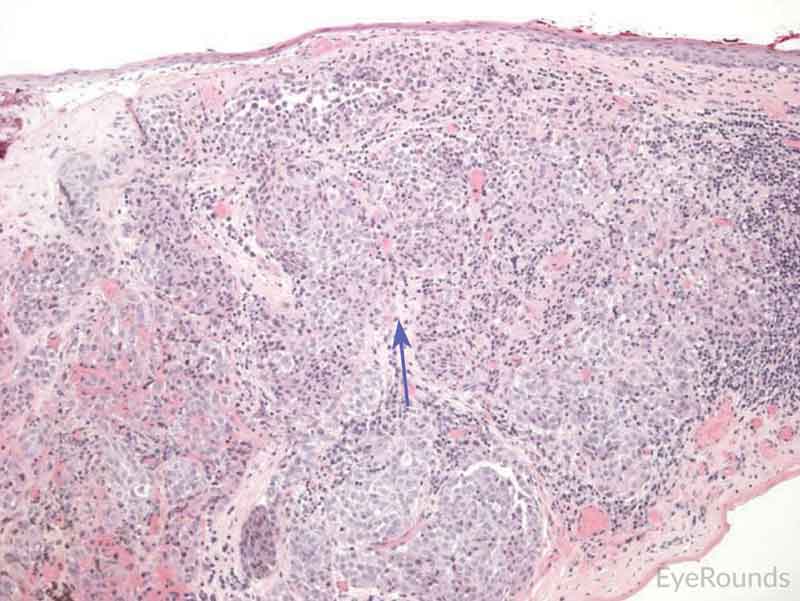 Primary acquired melanosis with severe atypia