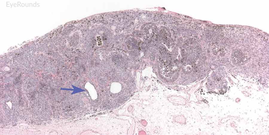 Hematoxylin and eosin stain displaying conjunctival nevus