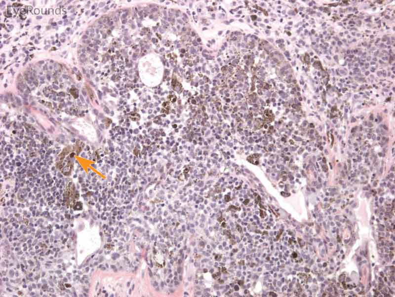 Hematoxylin and eosin stain displaying conjunctival nevus