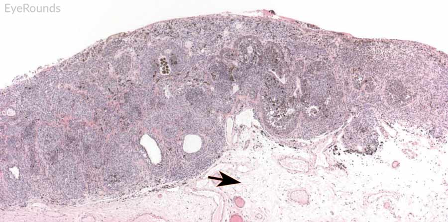 Hematoxylin and eosin stain displaying conjunctival nevus