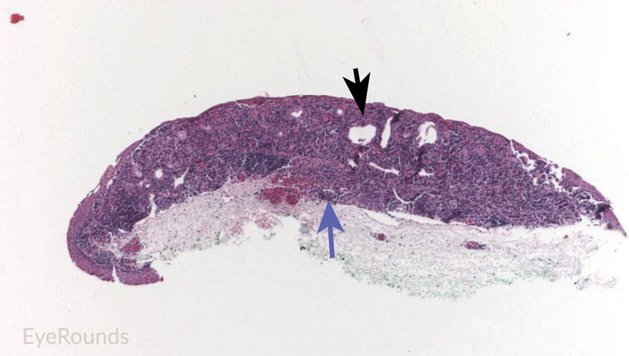 Hematoxylin and eosin stain displaying conjunctival nevus from young patient at the border of the basal epithelial layer and underlying substantia propria