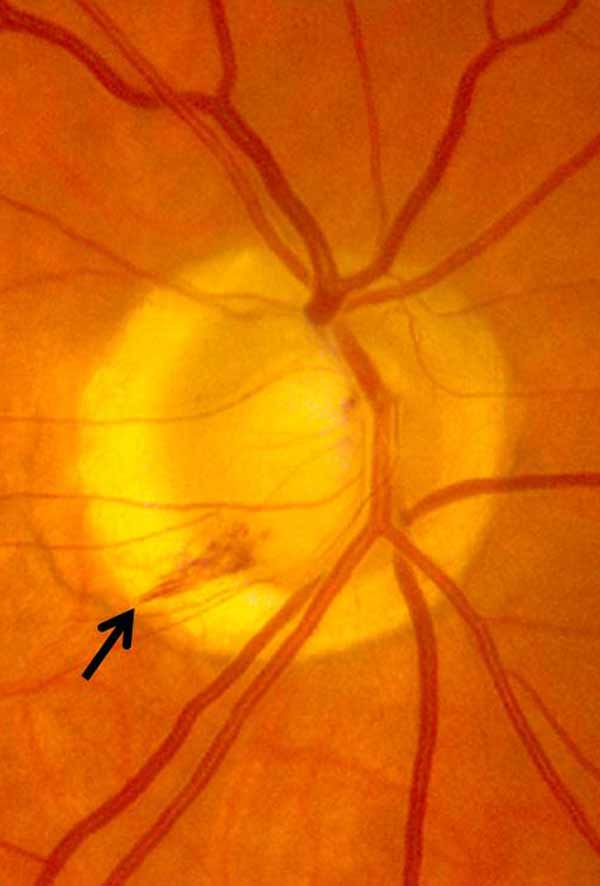 Fundus photograph demonstrating an inferotemporal hemorrhage 