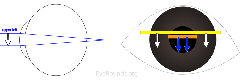 Figure 5: Left: Diagrammatic cross-section of a hyperopic eye, with rays of light entering the eye from the left and focusing posterior to the retina. The light that strikes the superior cornea is directed toward the superior retina and the light that strikes the inferior cornea is directed toward the inferior retina. Right: The light reflex visible in the pupil (illustrated by the orange bar) will move "with" the direction of the streak of light from the retinoscope (illustrated by the yellow bar). Thus, as the streak moves downward, the pupillary reflex also moves downward. 