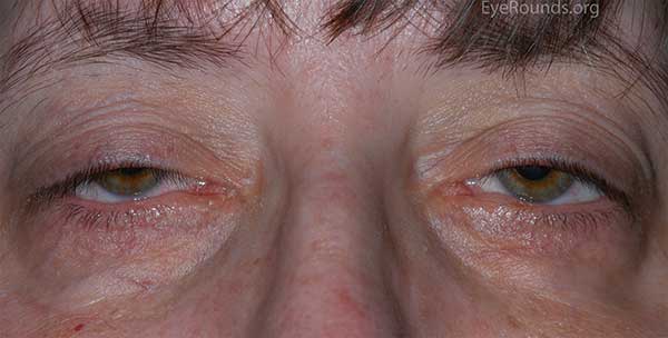 Bilateral ptosis in the setting of myotonic dystrophy