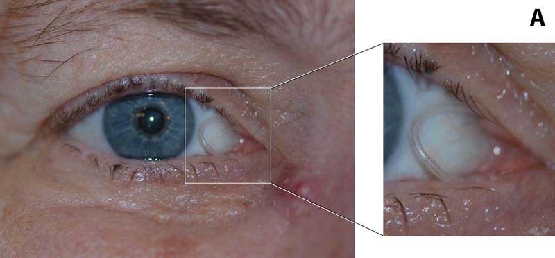 Various amounts of Crawford stent prolapse, (A) mild, (B) moderate, and (C) severe.