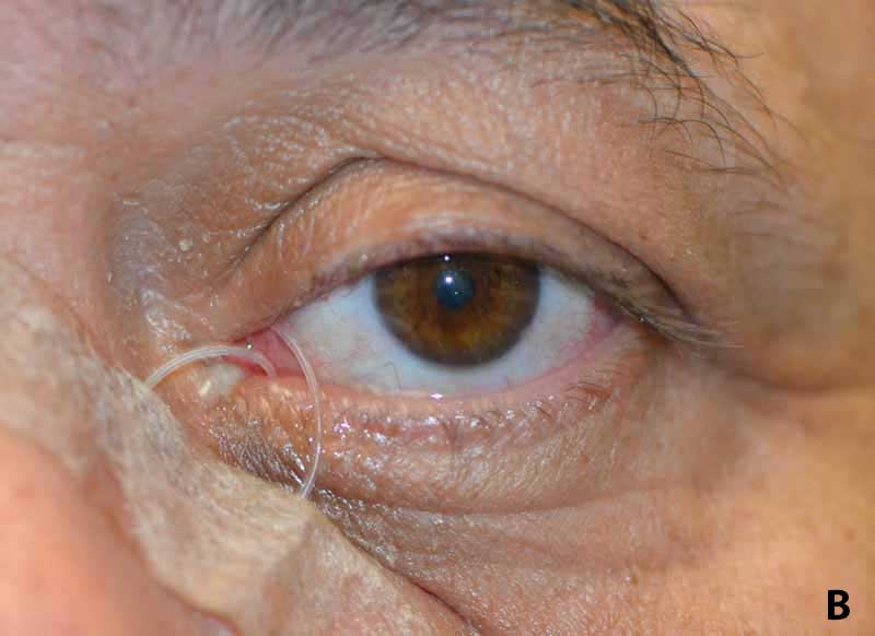 Various amounts of Crawford stent prolapse, (A) mild, (B) moderate, and (C) severe.