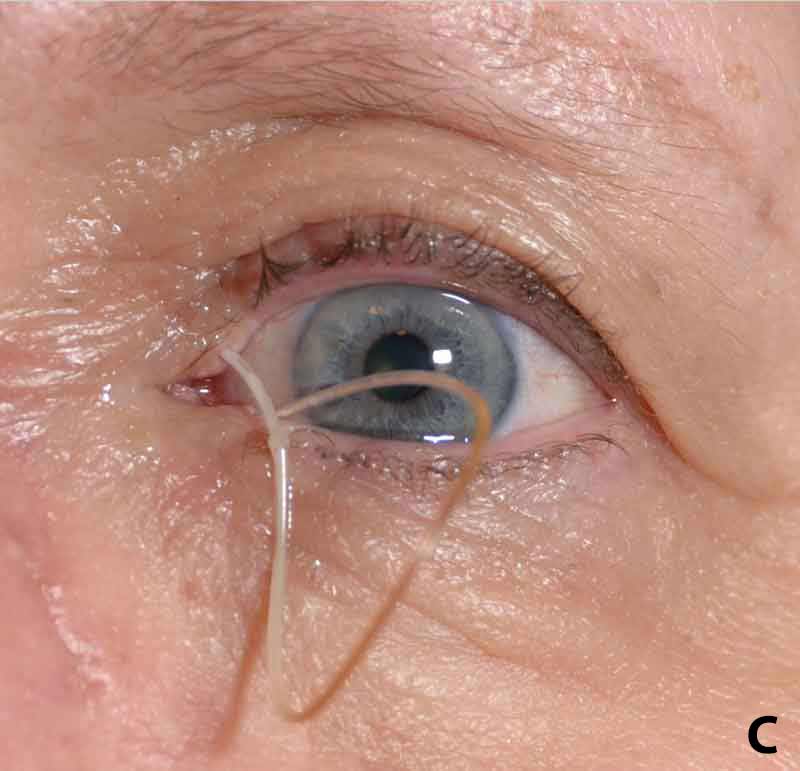 Various amounts of Crawford stent prolapse, (A) mild, (B) moderate, and (C) severe.