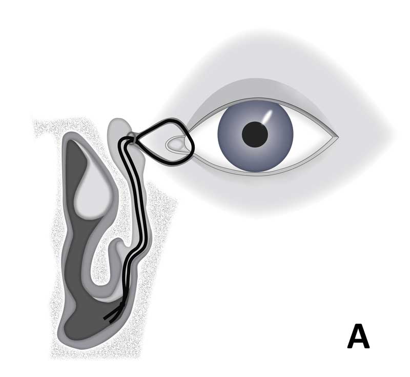 Diagrammatic representation of the different stents and the anatomical location they involve