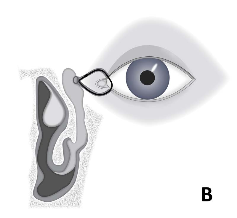 Diagrammatic representation of the different stents and the anatomical location they involve