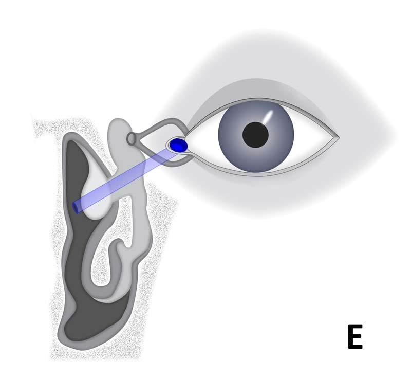 Diagrammatic representation of the different stents and the anatomical location they involve