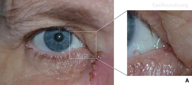 Silicone tubing of the Crawford stent connecting the upper and lower puncta and a healing incision from DCR.