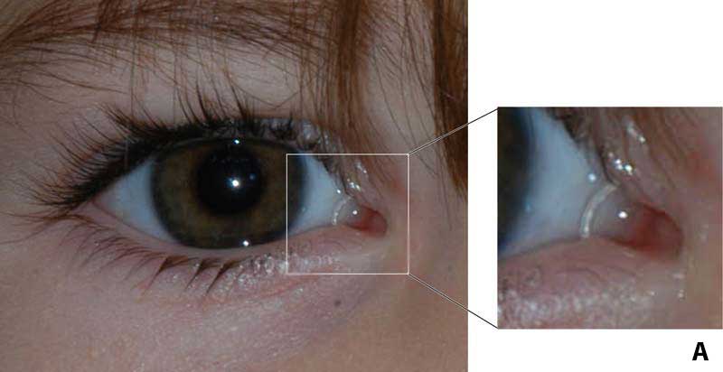 Silicone tubing of the Ritleng stent connecting the upper and lower puncta. Figure b compliments of FCI Ophthalmics.