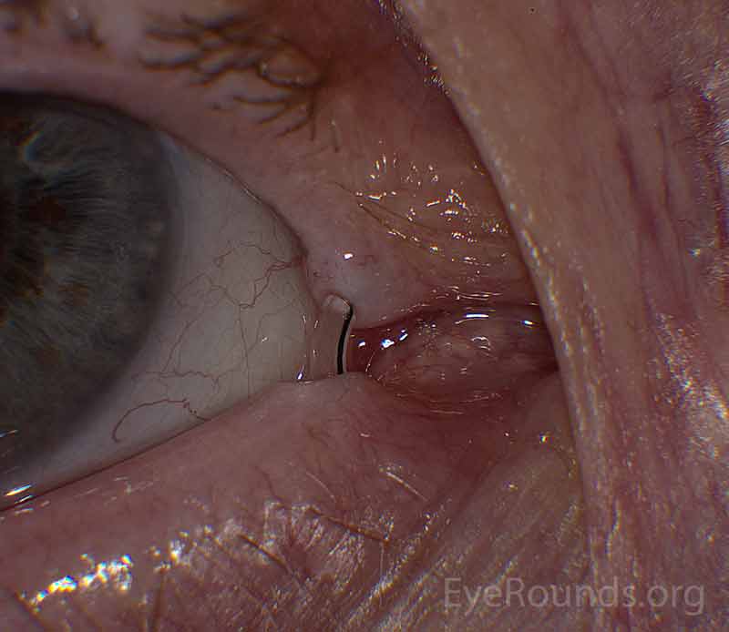 Pigtail stent with a black nylon suture visible within the stent lumen