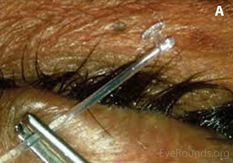 Mini Monoka stent over a patient's eyelids prior to insertion[1] 