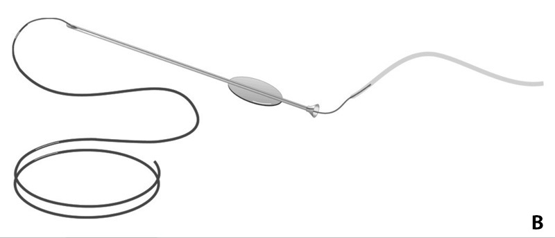 Diagram of stent with stylette, compliments of FCI Ophthalmics