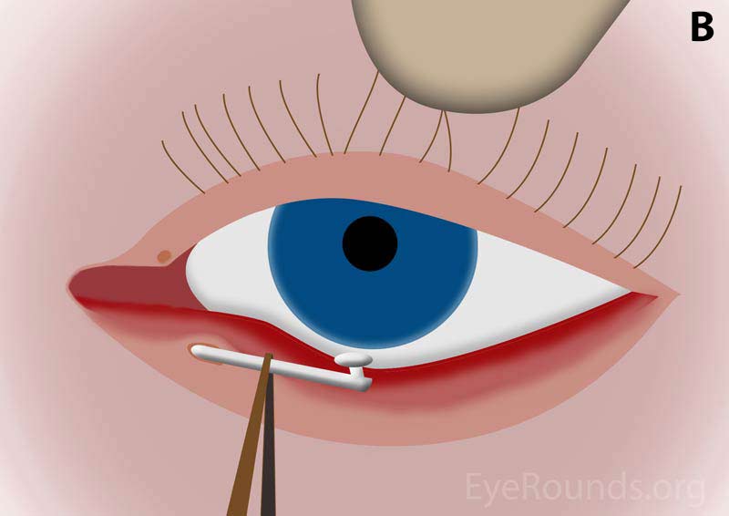 Diagram demonstrating insertion of the stent into the inferior punctum