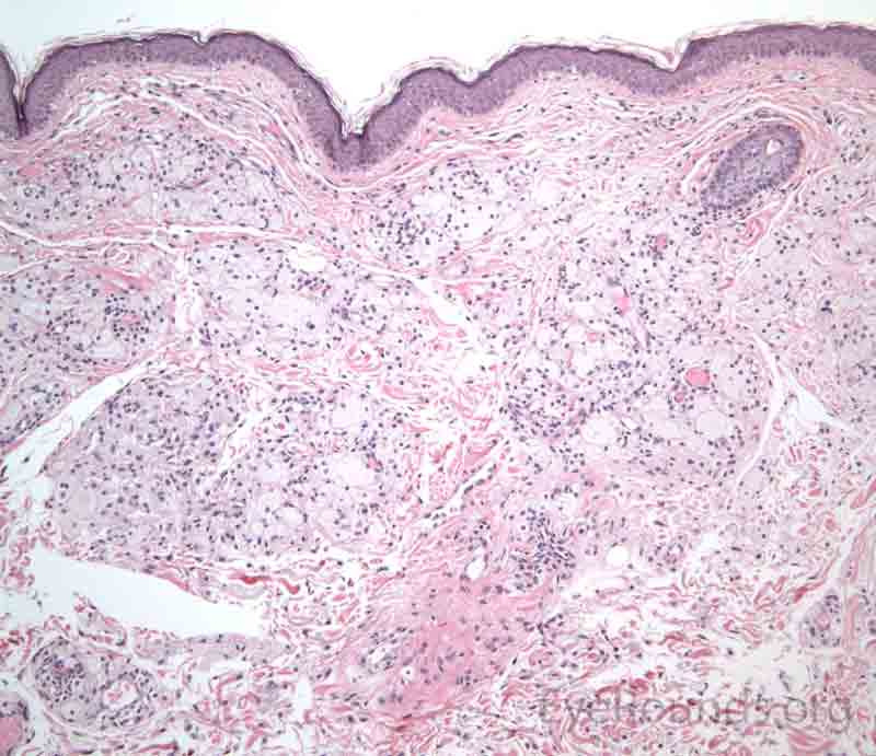 Xanthelasma pathology 