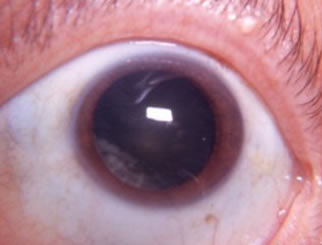 Cortical Cataract