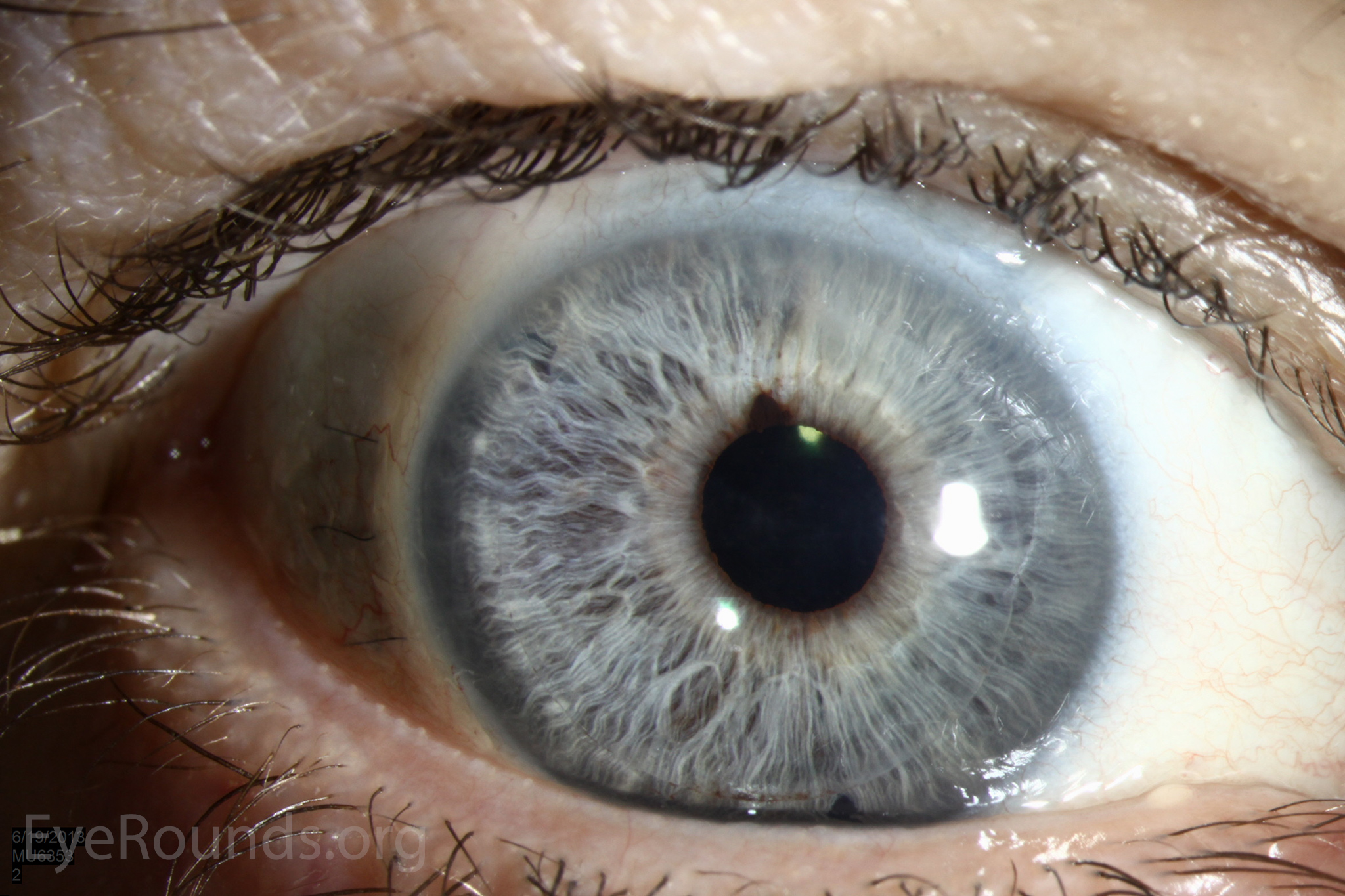  Anterior segment optical coherence tomography