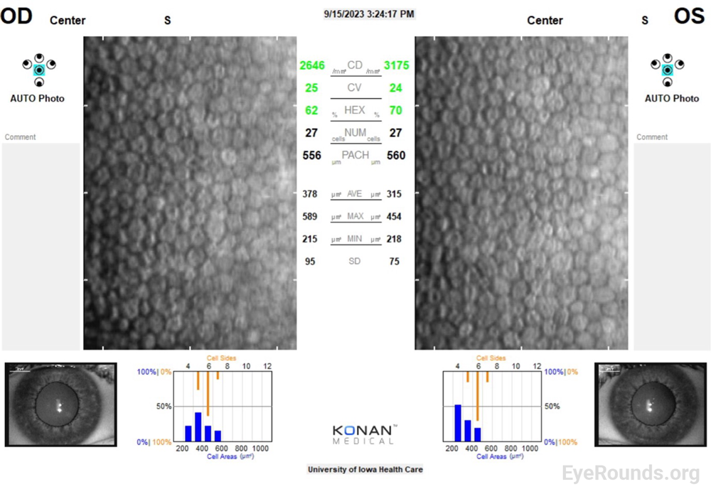 Specular microscopy demonstrating healthy corneal endothelial cells with characteristic hexagonal morphology.  Note, endothelial cell density is within a normal range for an adult patient (2646 cells/mm2 on the right, 3175 cells/mm2 on the left). 