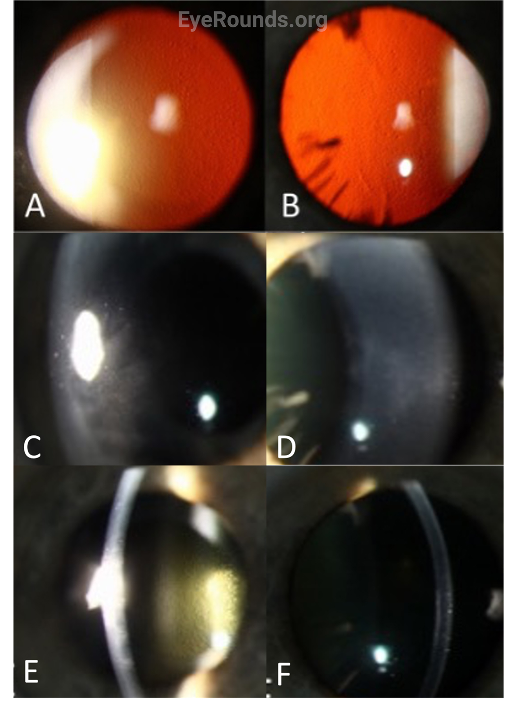 slit lamp photo of the right and left eyes