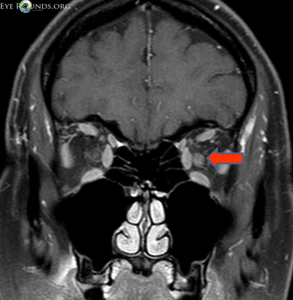 MRI with contrast showing enhancing lft optic nerve 