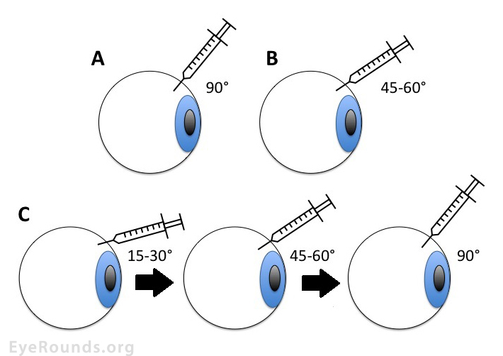 Schematic illustration of three different needle path penetration techniques