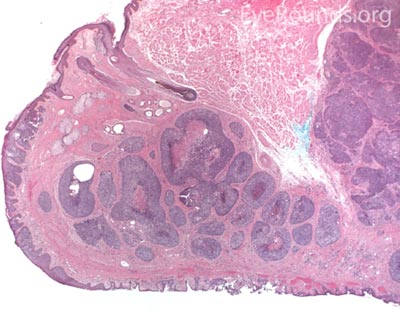  Sebaceous Gland Carcinoma 