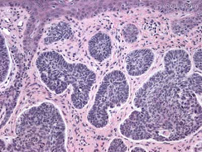 monomorphic nuclei with high nuclear/cytoplasmic ratio in several cohesive nests lying within the dermis 