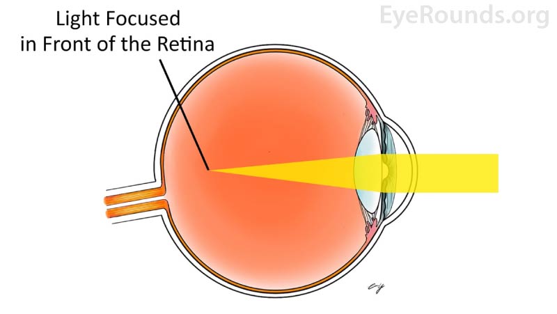In myopia, the eye is too long or the cornea is too steep. Distant objects appear blurry because images are focused anterior to the retina.