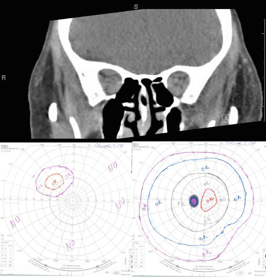 Compressive optic neuropathy. This sequence shows a series of CT scans from patients with compressive optic neuropathy, with their associated visual fields