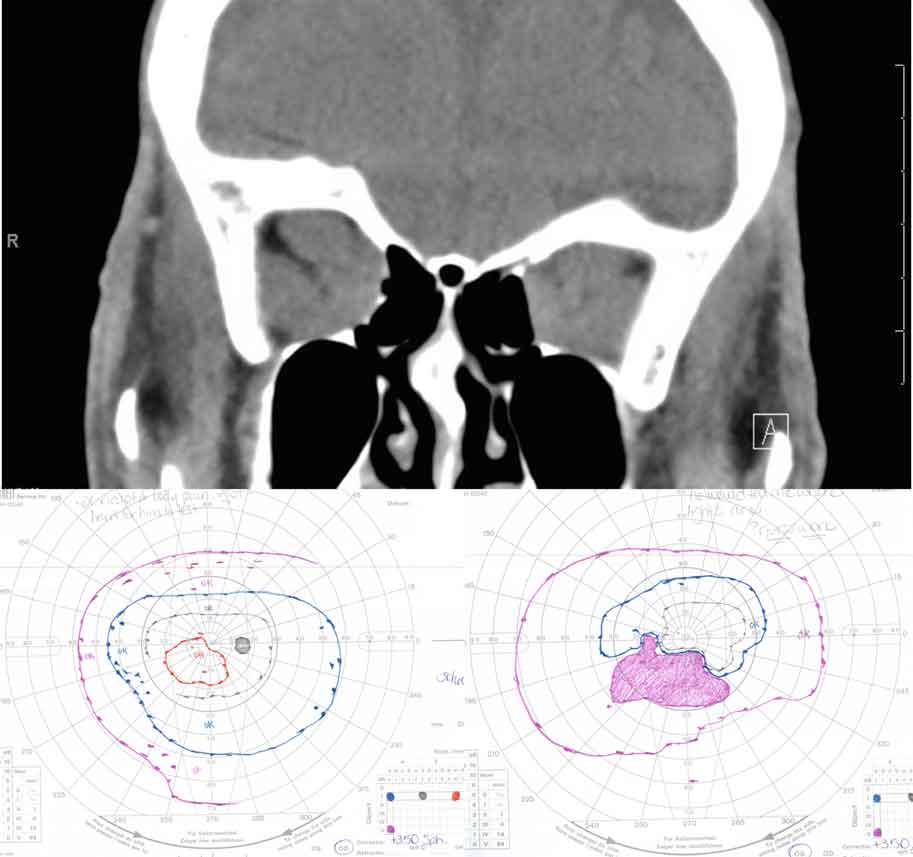 Compressive optic neuropathy. This sequence shows a series of CT scans from patients with compressive optic neuropathy, with their associated visual fields