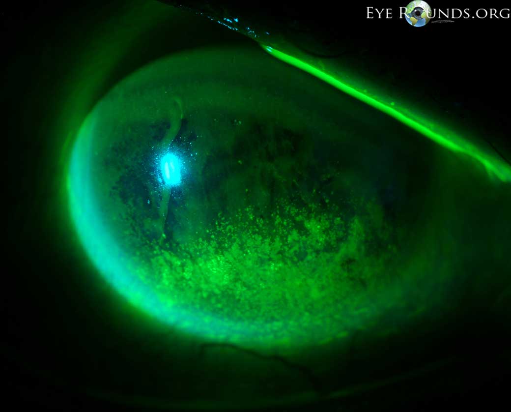 Exposure keratopathy. Punctate epithelial erosions (PEE) secondary to exposure keratopathy.