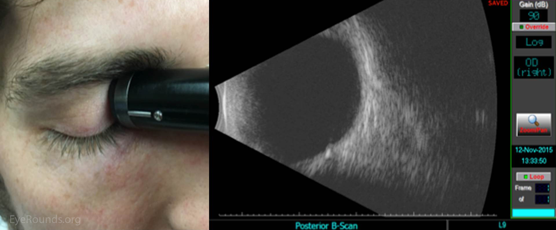 B scan ultrasound in ophthalmology