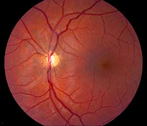 Pediatric Ophthalmology and Strabismus